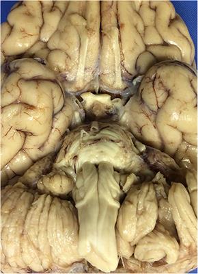 Hypertrophy of the Anterior External Arcuate Fasciculus: A Rare Variant With Implications for the Development of the Arcuate Nucleus